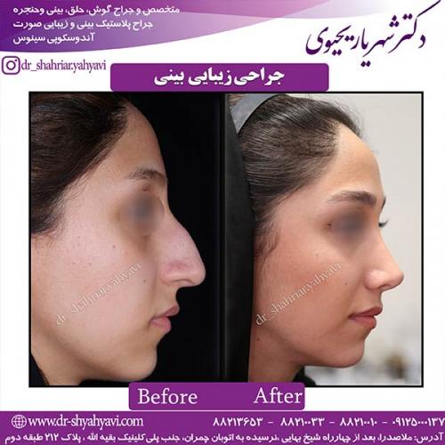 جراحی-بینی-139