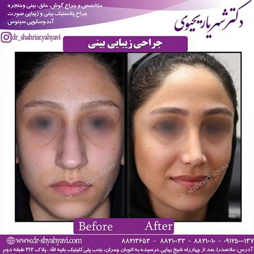 جراحی-بینی-140