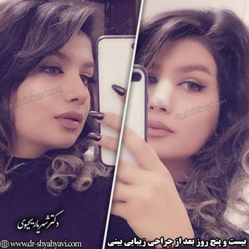 جراحی-بینی-141