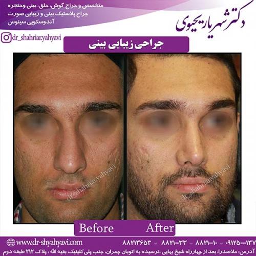 جراحی-بینی-142
