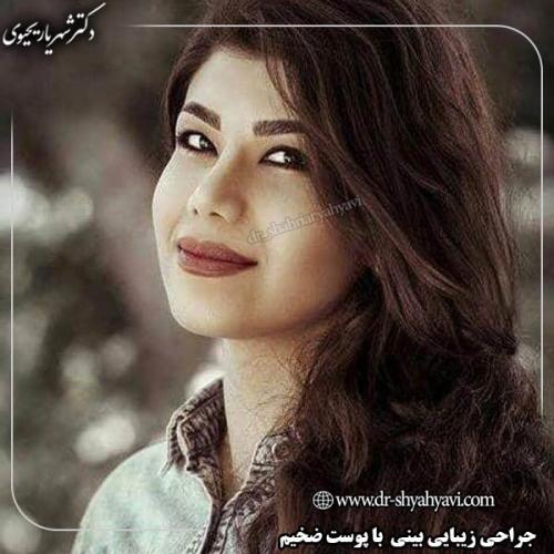 جراحی-بینی-143