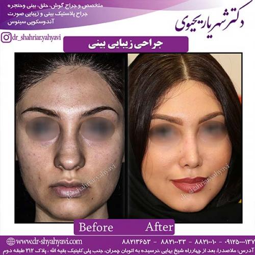 جراحی-بینی-144