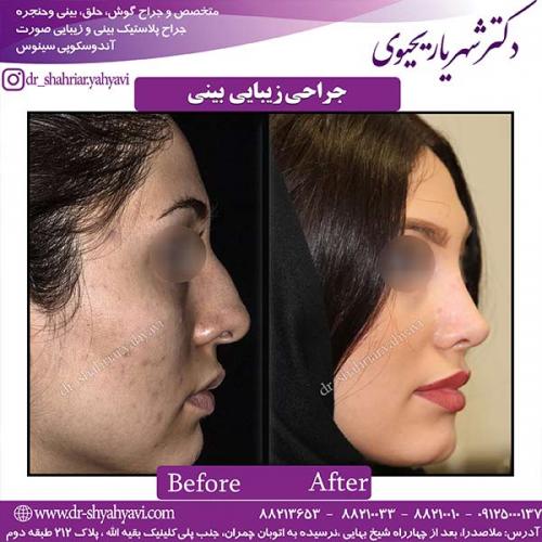 جراحی-بینی-145