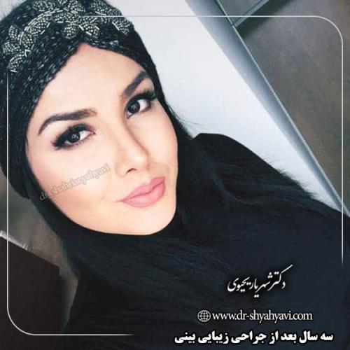 جراحی-بینی-146