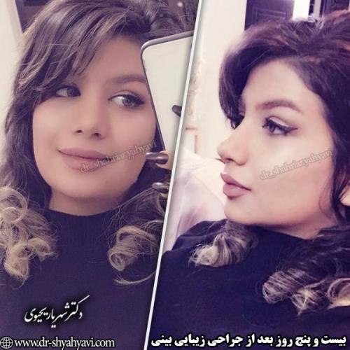 جراحی-بینی-147