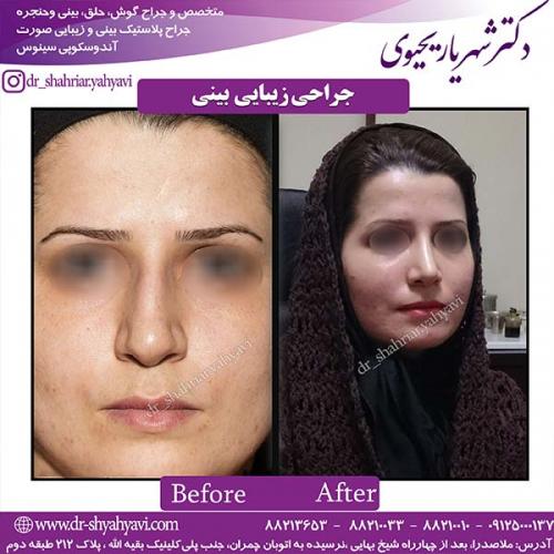 جراحی-بینی-148