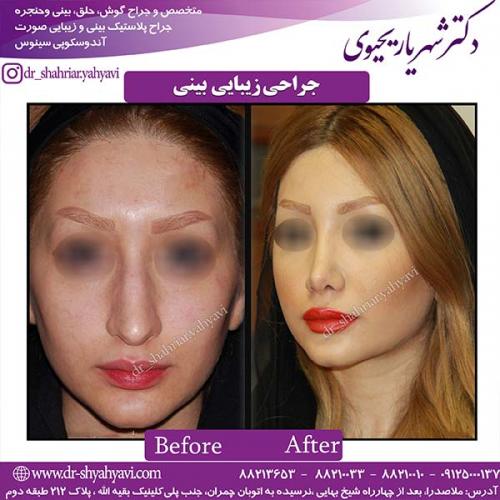 جراحی-بینی-149