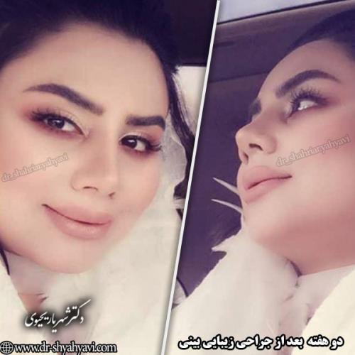 جراحی-بینی-150