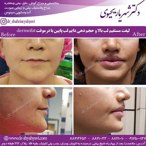 جراحی-بینی-151