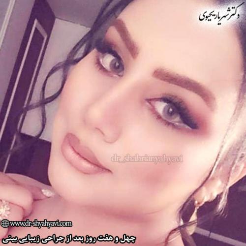 جراحی-بینی-152