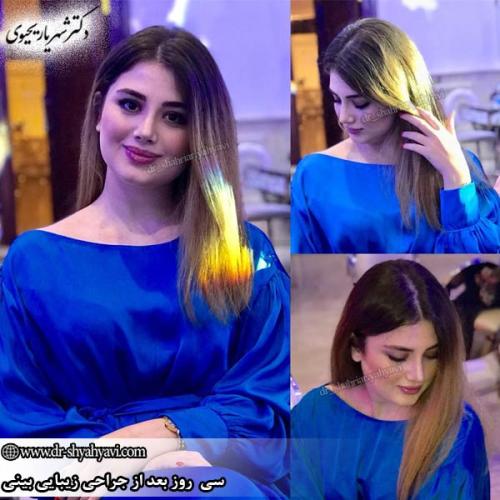 جراحی-بینی-153