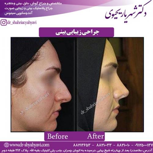 جراحی-بینی-155