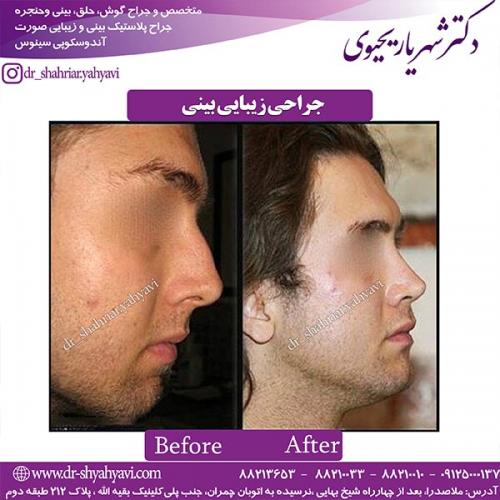 جراحی-بینی-157