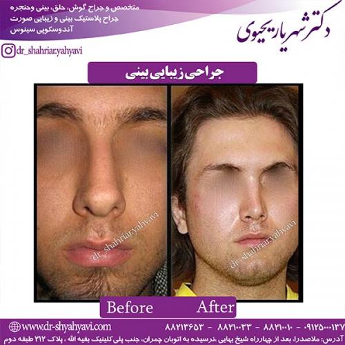 جراحی-بینی-158