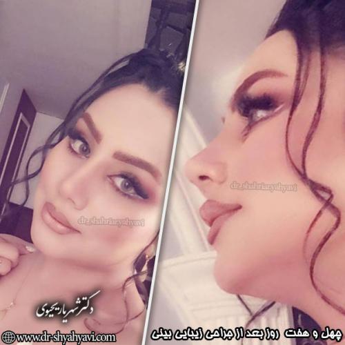 جراحی-بینی-160