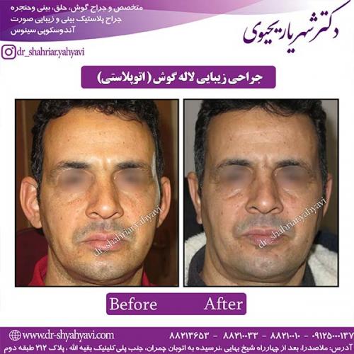 جراحی-بینی-161