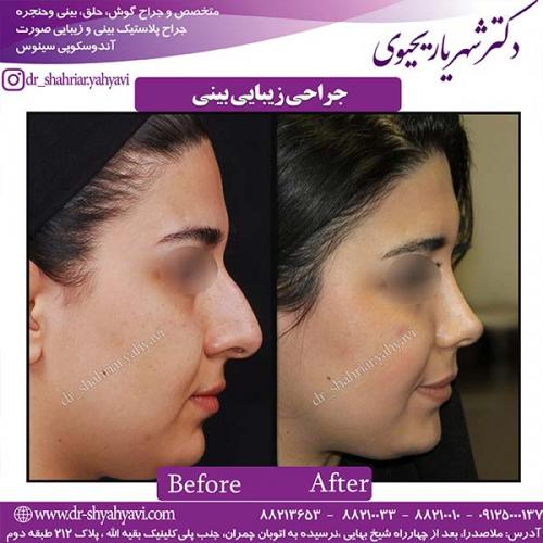 جراحی-بینی-162