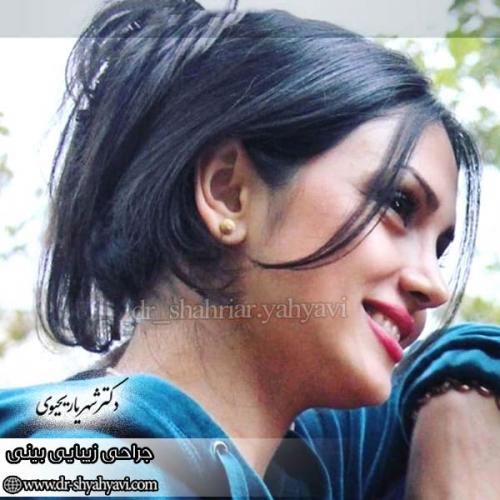 جراحی-بینی-163