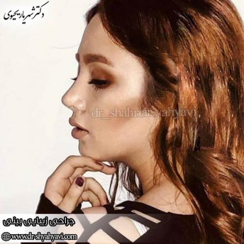 جراحی-بینی-165