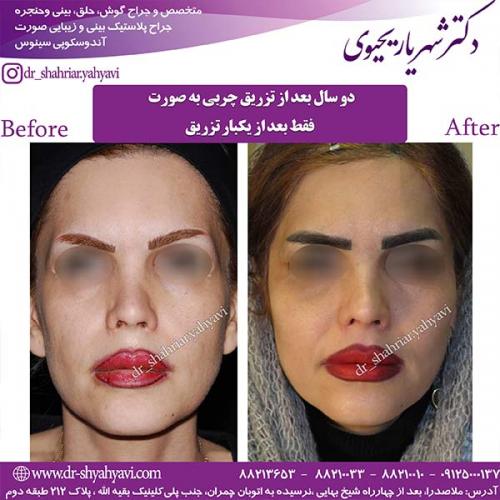جراحی-بینی-166