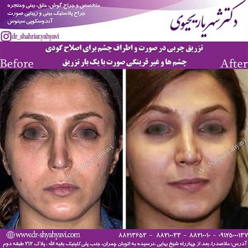 جراحی-بینی-168