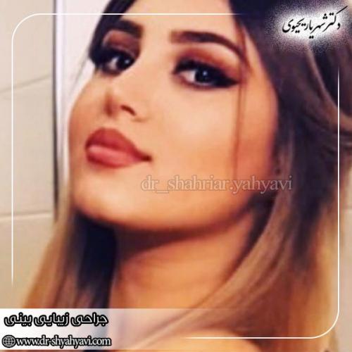 جراحی-بینی-169