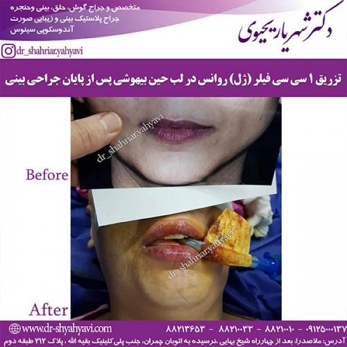 جراحی-بینی-170