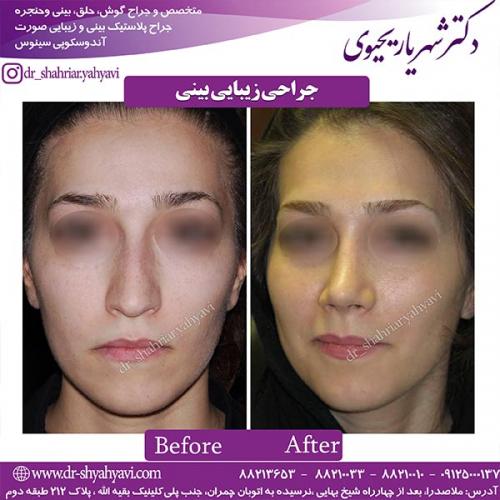 جراحی-بینی-172