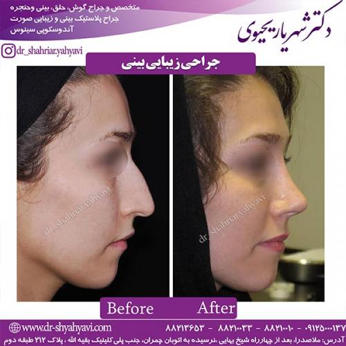 جراحی-بینی-173