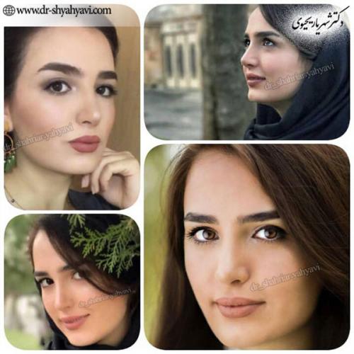 جراحی-بینی-174