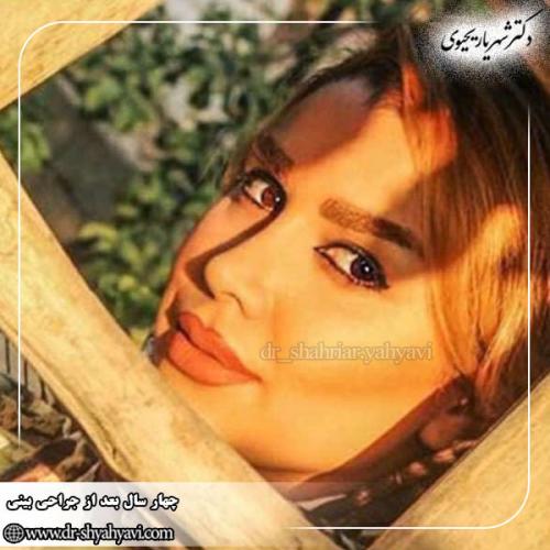 جراحی-بینی-175