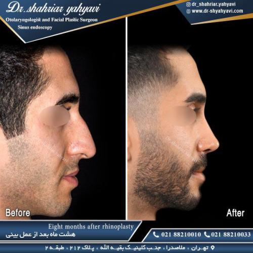 جراحی-بینی-505