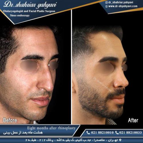 جراحی-بینی-506