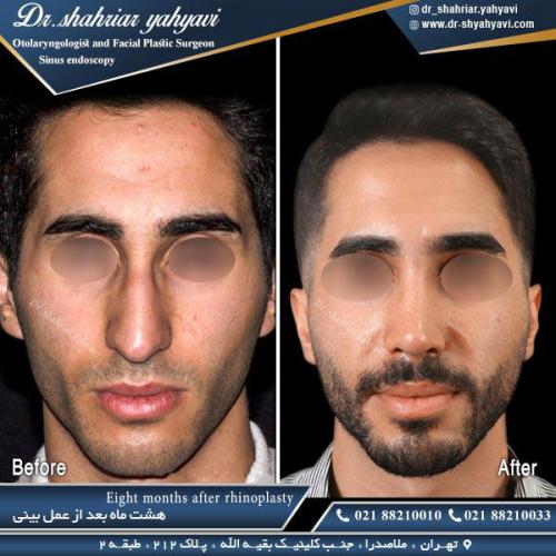 جراحی-بینی-507