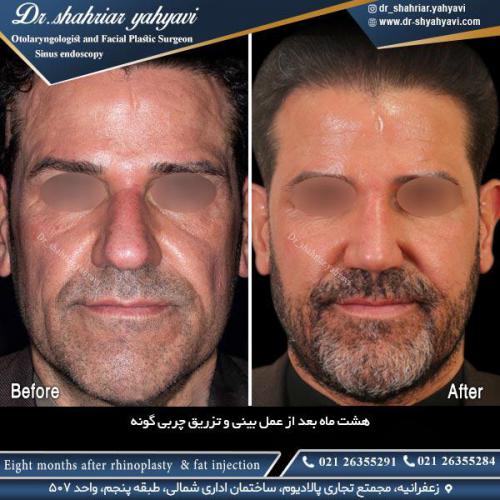 جراحی-بینی-508