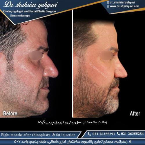 جراحی-بینی-509