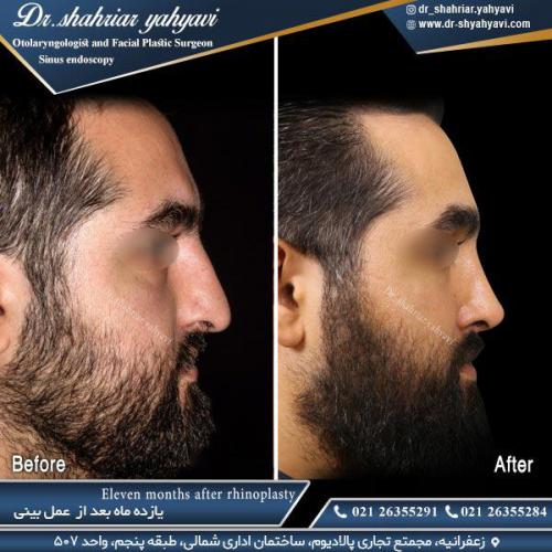 جراحی-بینی-510