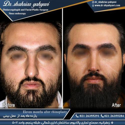 جراحی-بینی-511