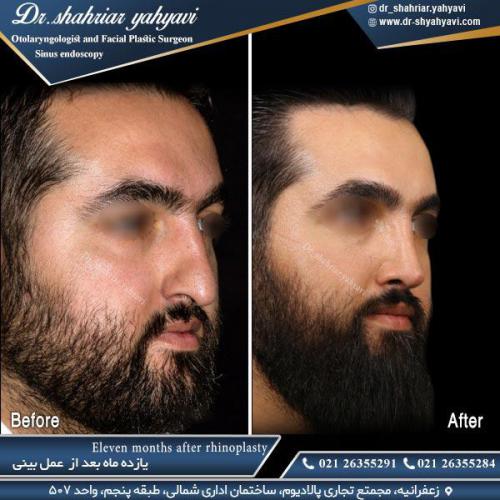 جراحی-بینی-512