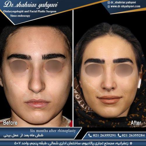 جراحی-بینی-513