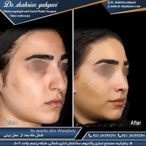 جراحی-بینی-514