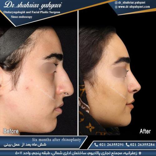 جراحی-بینی-515