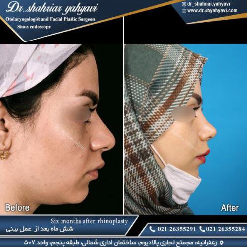 جراحی-بینی-516