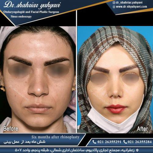 جراحی-بینی-517
