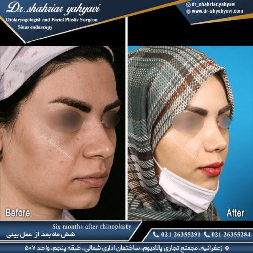 جراحی-بینی-518
