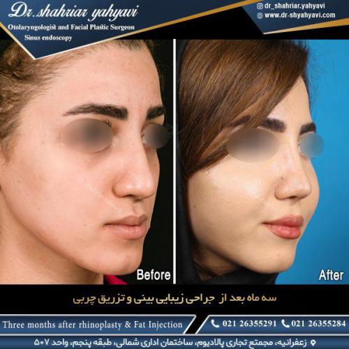 جراحی-بینی-519