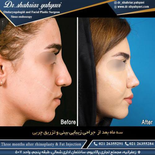 جراحی-بینی-520