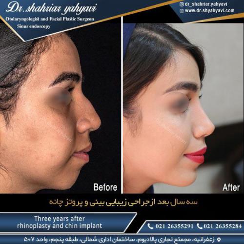 جراحی-بینی-523