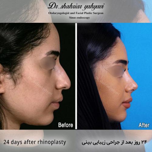 جراحی-بینی-530