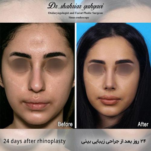 جراحی-بینی-532